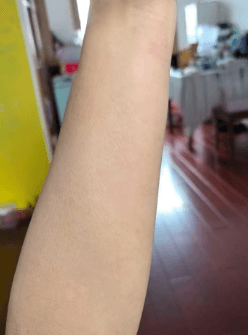 Arm Comparison After