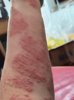 Arm Comparison Before