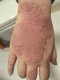 Hand Comparison Before