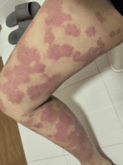 Leg Comparison Before