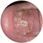 Nail Psoriasis