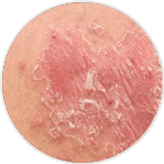 Psoriasis Vulgaris (Plaque Psoriasis)